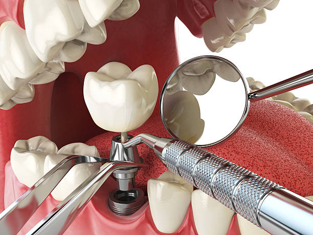Best Emergency Wisdom Tooth Extraction in Dulles Town Center, VA